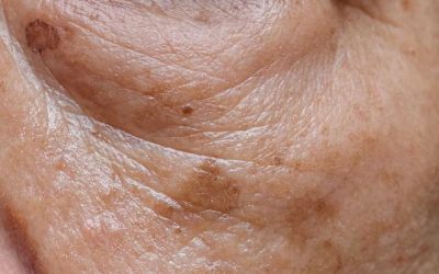 The Number One Deficiency Behind Aging Spots — And How to Naturally Address It Step by Step 🌿