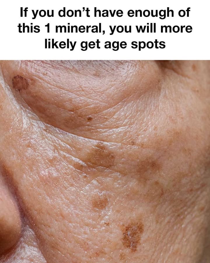 The Number One Deficiency Behind Aging Spots — And How to Naturally Address It Step by Step 🌿