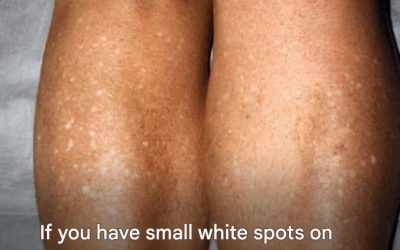 Have You Noticed Small White Spots on Your Arms or Legs? Here’s What They Are