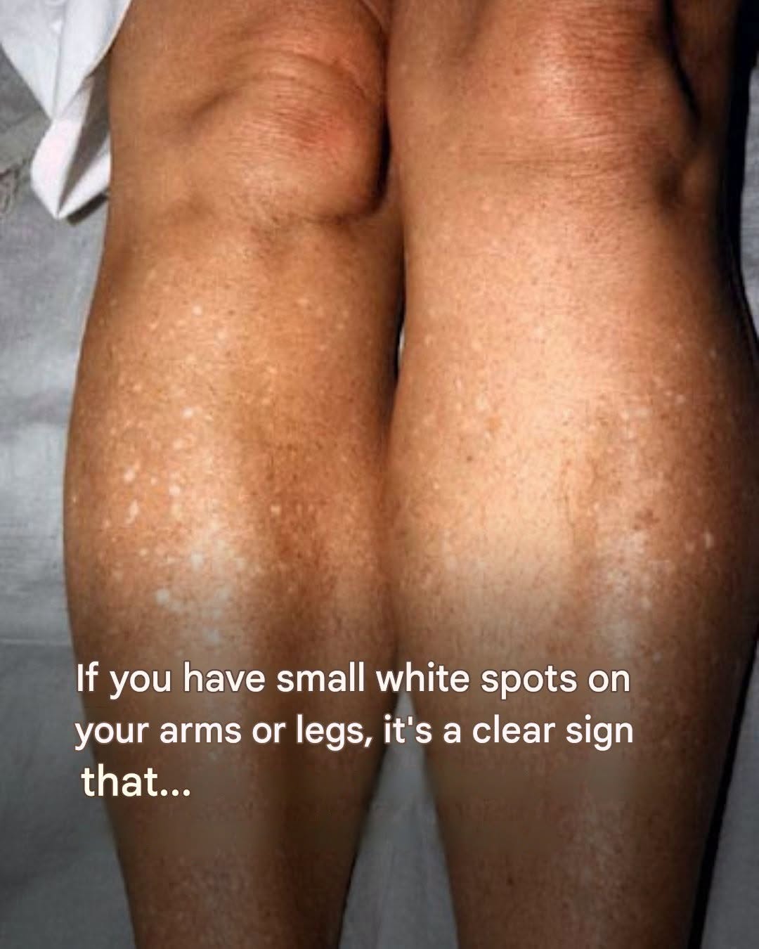 Have You Noticed Small White Spots on Your Arms or Legs? Here’s What They Are