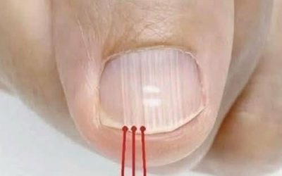 Vertical streaks on the nails: your body’s hidden message