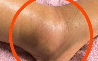 If you notice your legs are swollen, that’s a sign of ca…